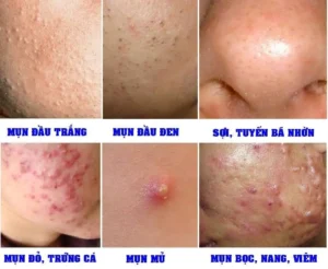 Đối tượng nào không nên lăn kim trị nám