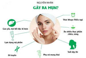 Nguyên nhân gây mụn